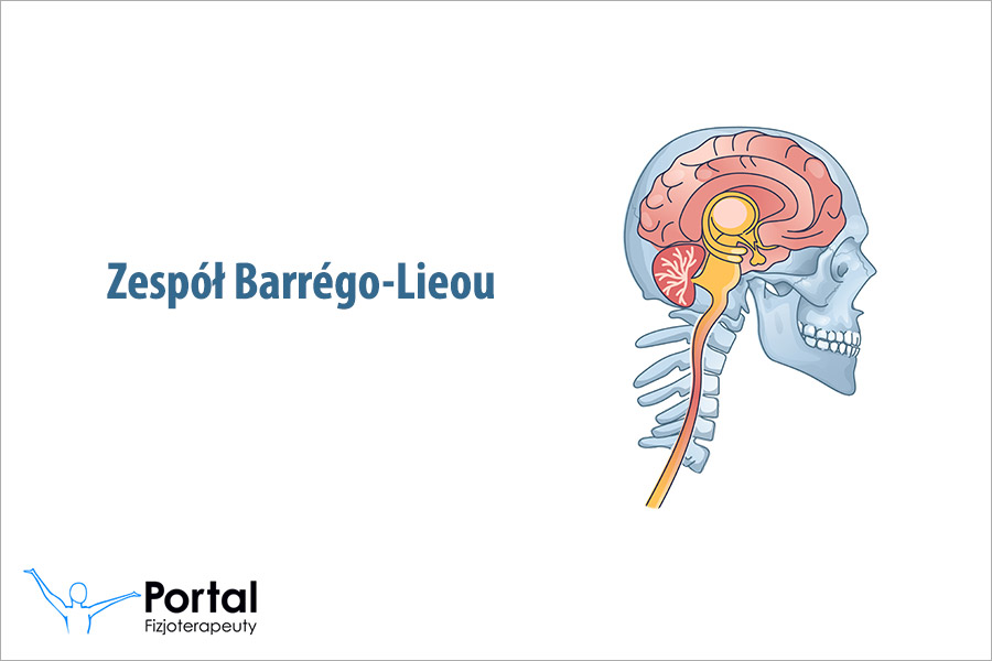 Zespół Barrégo-Lieou
