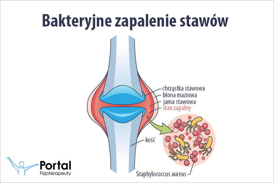 Bakteryjne zapalenie stawów