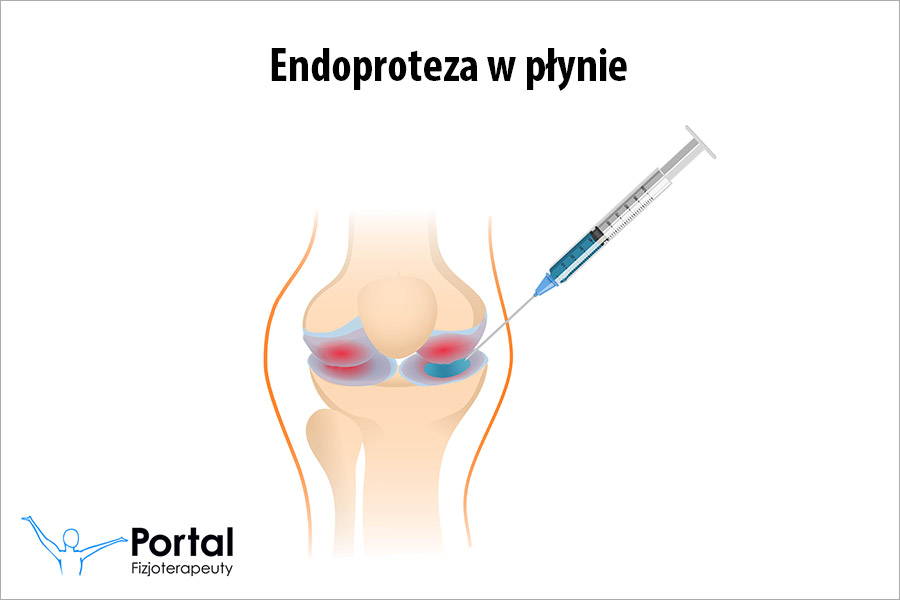 Endoproteza w płynie