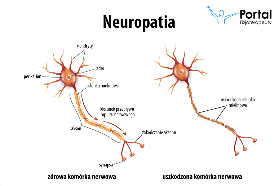 Neuropatia