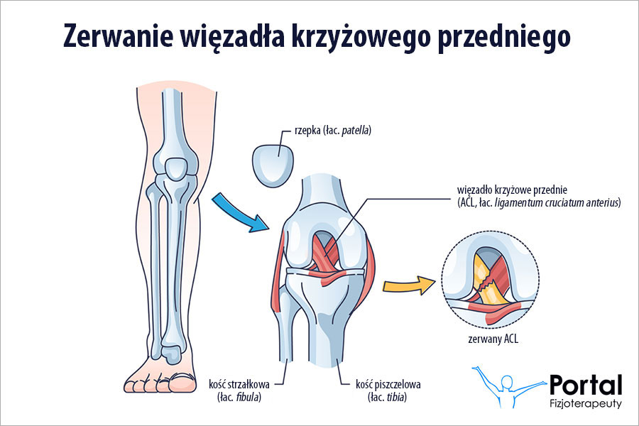 Rekonstrukcja więzadła krzyżowego przedniego