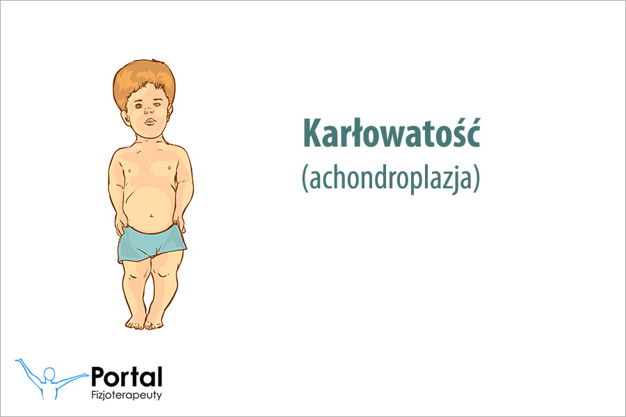 Karłowatość (achondroplazja)
