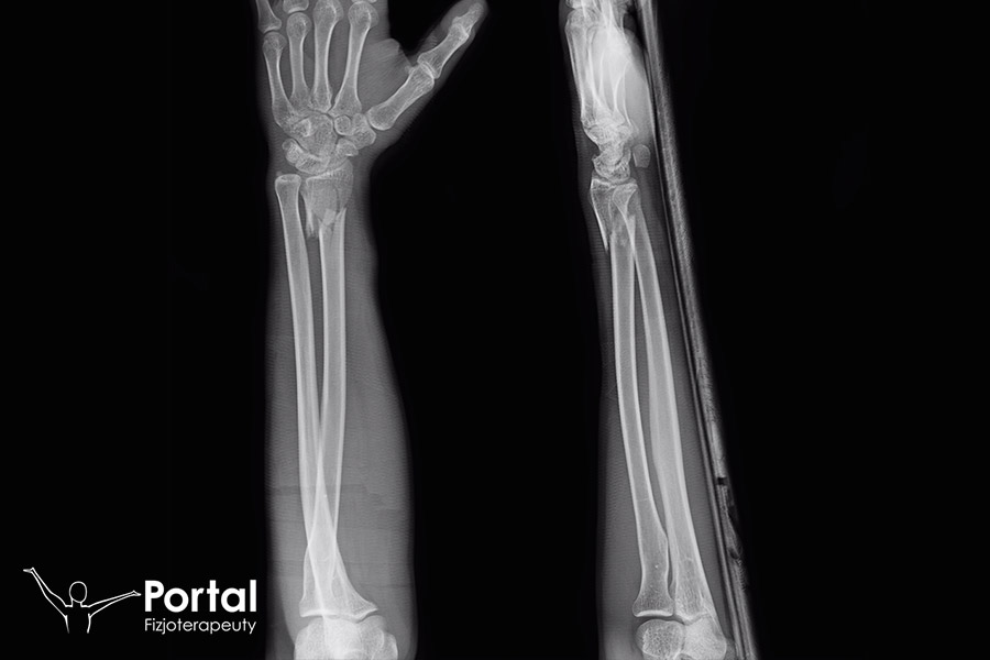 Złamanie Galeazziego