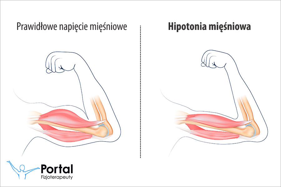 Hipotonia mięśniowa
