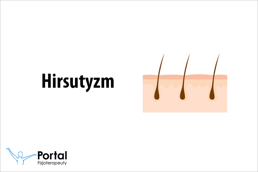 Hirsutyzm