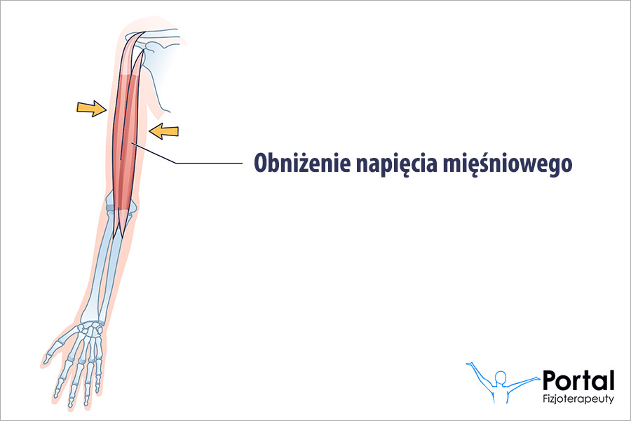 Obniżenie napięcia mięśniowego