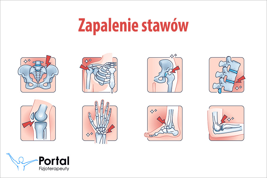 Zapalenie stawów
