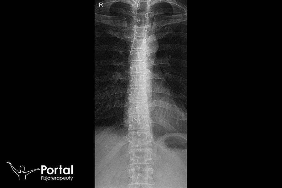 Ból w kręgosłupie piersiowym