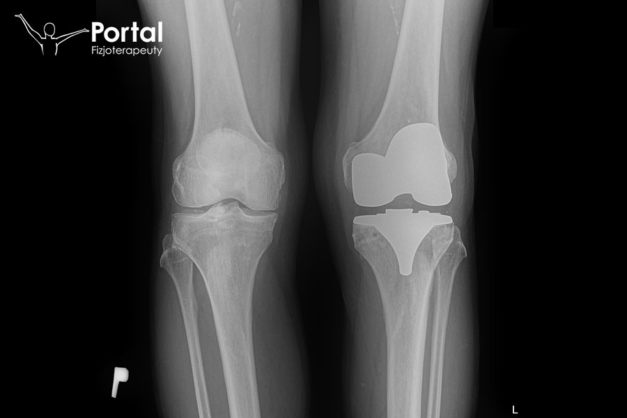 Endoprotezoplastyka staw kolanowy