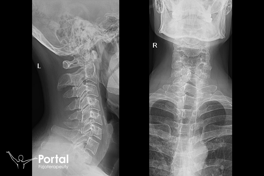 Odcinek szyjny kręgosłupa
