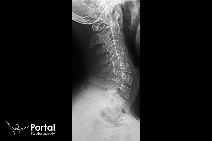 Odprostowanie lordozy szyjnej
