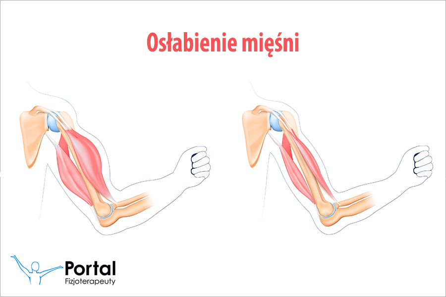 Osłabienie mięśni