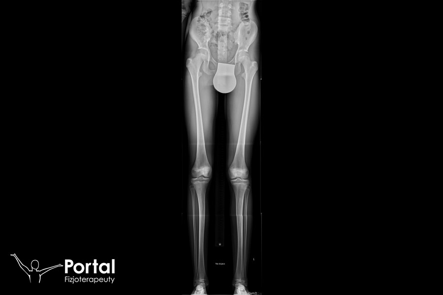 Asymetria długości kończyn dolnych