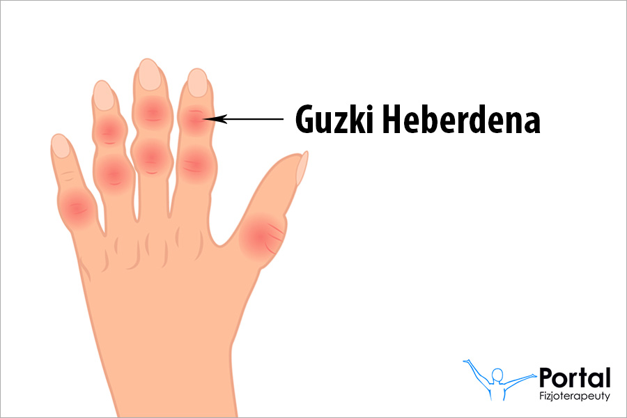 Guzki Heberdena
