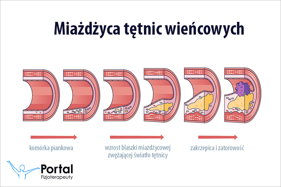 Miażdżyca tętnic wieńcowych